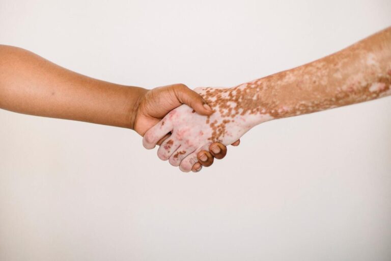 psoriasis på hænder