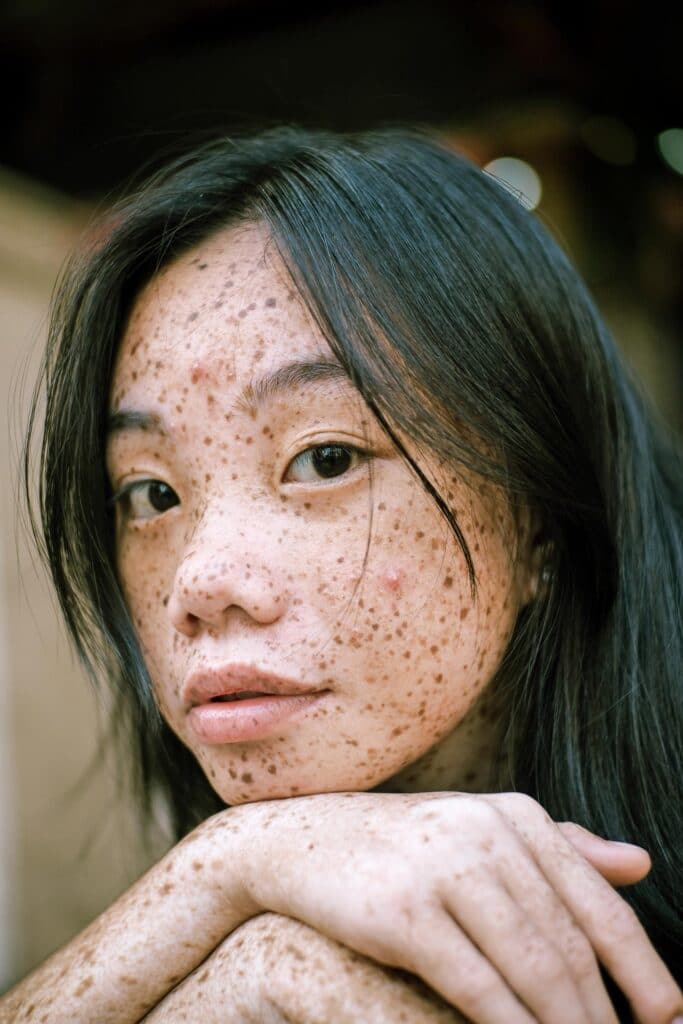 Eksempel på kvinde med uren hud i ansigtet