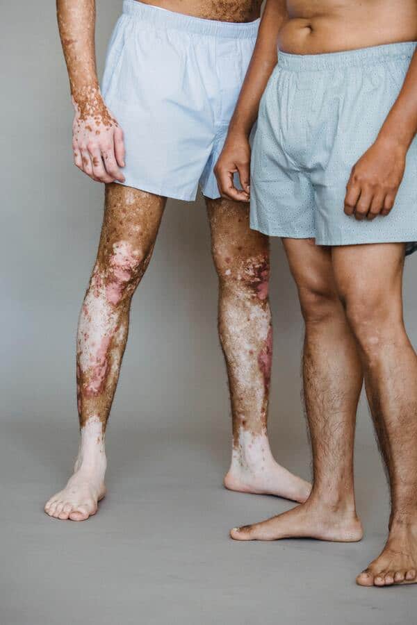 Psoriasis hud på ben og hænder