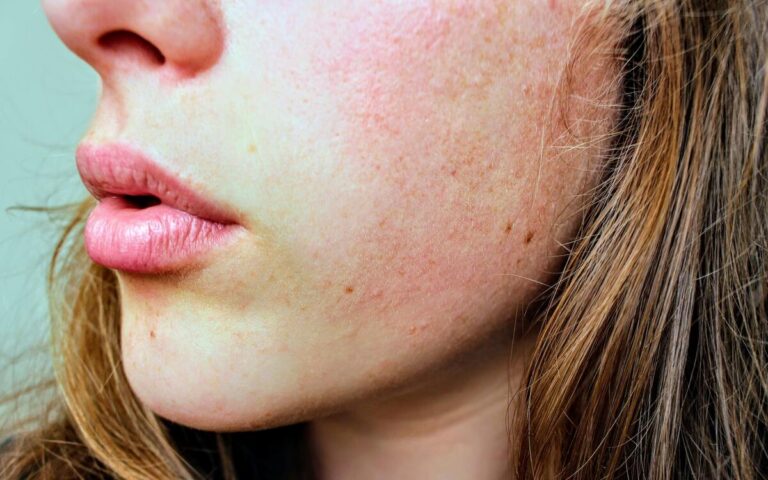 rosacea